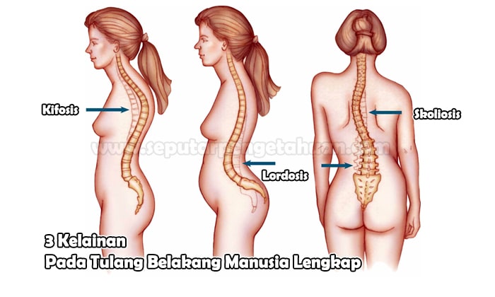 Detail Contoh Gambar Kelainan Tulang Nomer 43