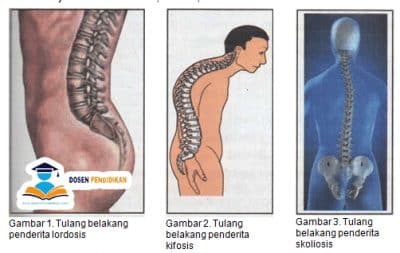 Detail Contoh Gambar Kelainan Tulang Nomer 50