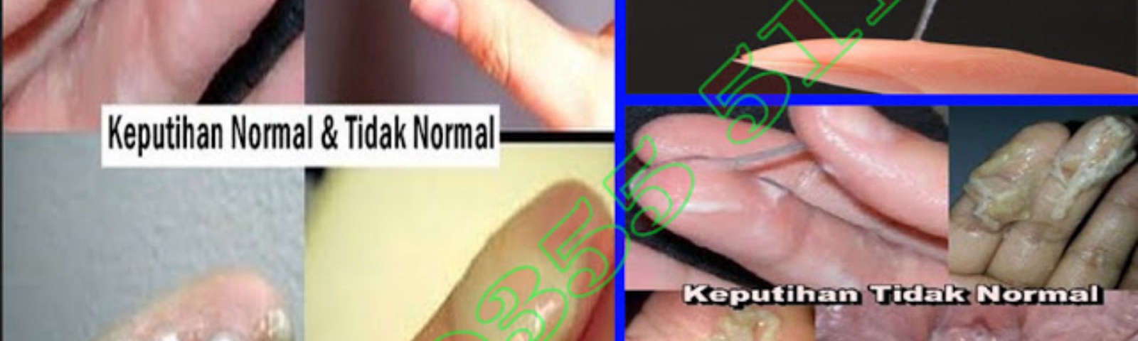 Detail Contoh Gambar Keputihan Normal Nomer 34