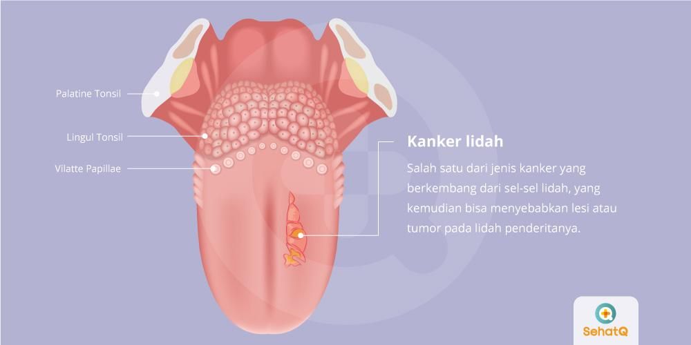 Detail Contoh Gambar Lidah Yg Sehat Nomer 46