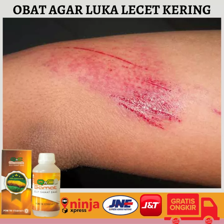 Detail Contoh Gambar Luka Lecet Nomer 26