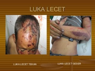 Detail Contoh Gambar Luka Lecet Nomer 49