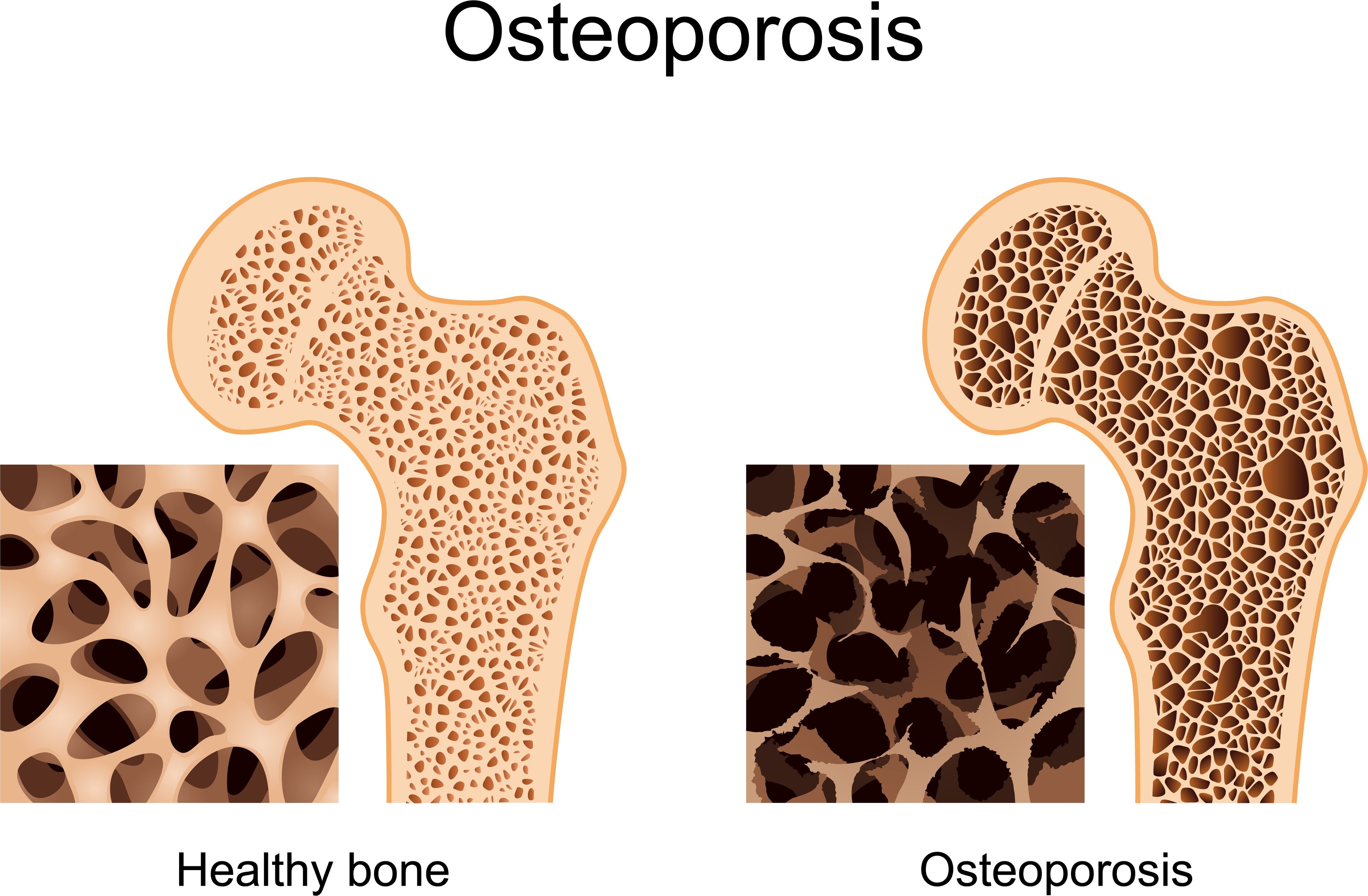 Contoh Gambar Osteoporosis - KibrisPDR