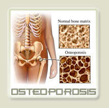 Detail Contoh Gambar Osteoporosis Nomer 21