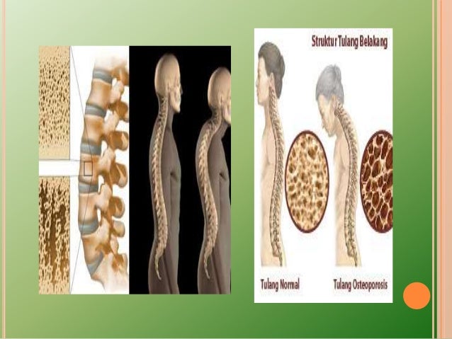 Detail Contoh Gambar Osteoporosis Nomer 26