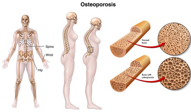 Detail Contoh Gambar Osteoporosis Nomer 28