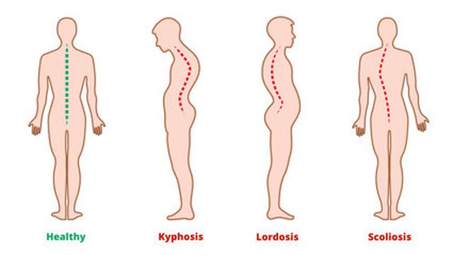 Detail Contoh Gambar Osteoporosis Nomer 32