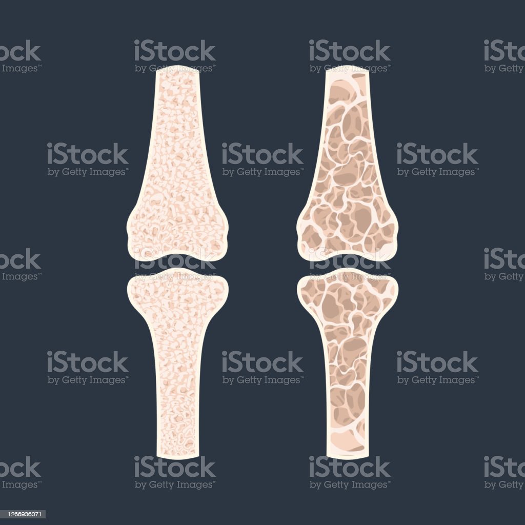 Detail Contoh Gambar Osteoporosis Nomer 8