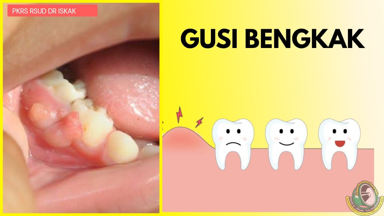 Detail Gambar Gusi Bengkak Nomer 4