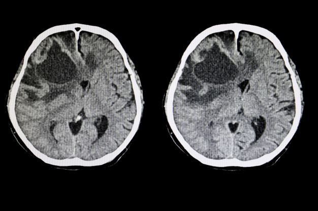 Detail Gambar Hasil Ct Scan Tumor Otak Nomer 1