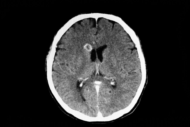 Detail Gambar Hasil Ct Scan Tumor Otak Nomer 13