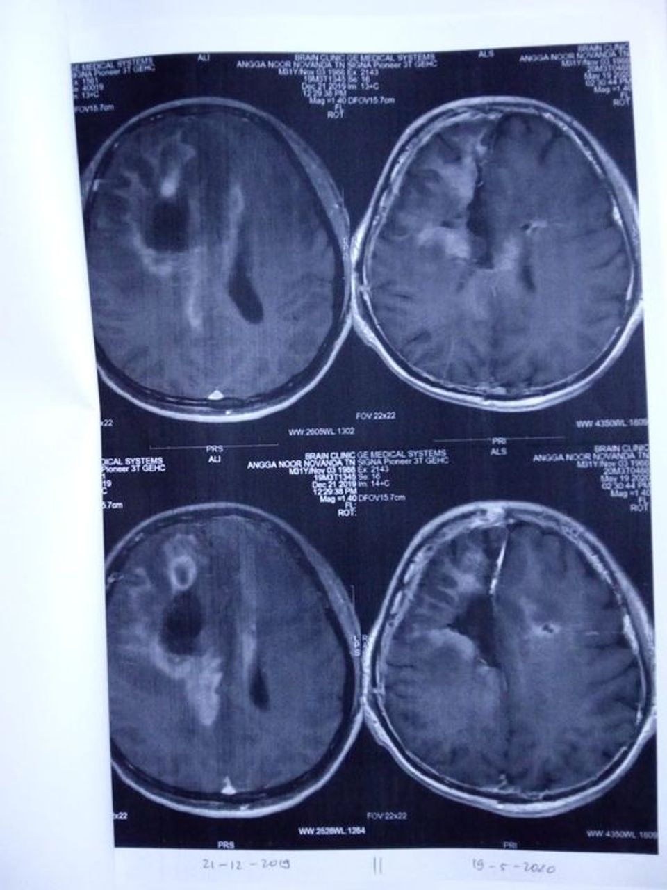 Detail Gambar Hasil Ct Scan Tumor Otak Nomer 15