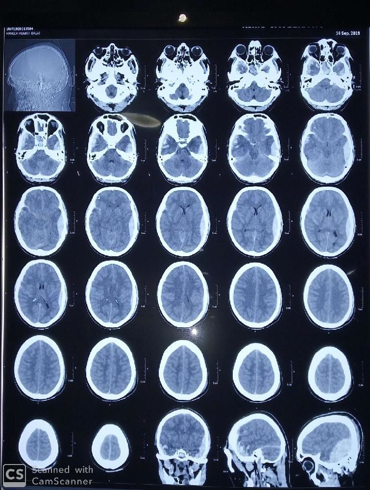Detail Gambar Hasil Ct Scan Tumor Otak Nomer 16