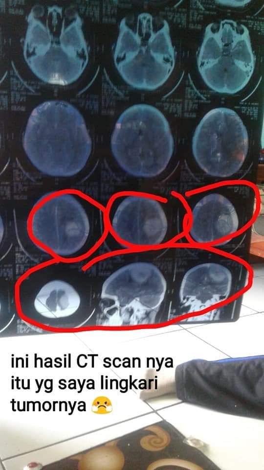 Detail Gambar Hasil Ct Scan Tumor Otak Nomer 17