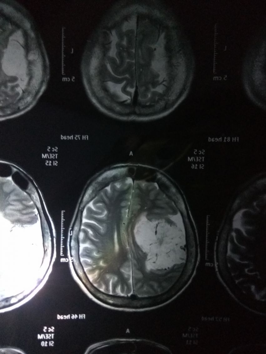 Detail Gambar Hasil Ct Scan Tumor Otak Nomer 21
