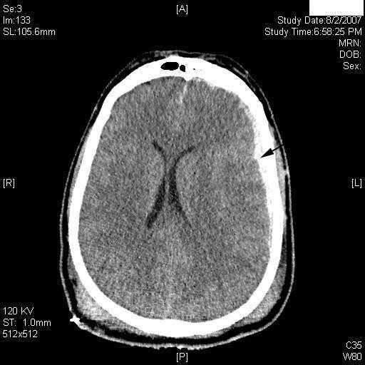Detail Gambar Hasil Ct Scan Tumor Otak Nomer 22
