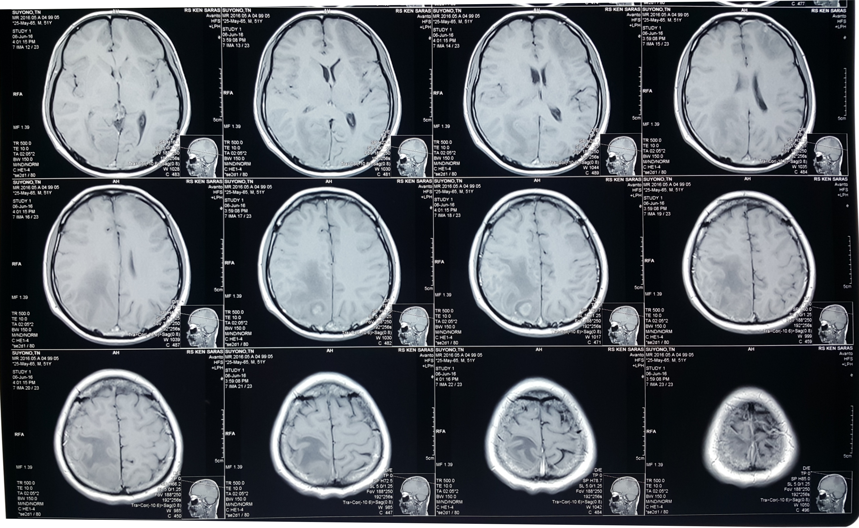 Detail Gambar Hasil Ct Scan Tumor Otak Nomer 23