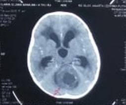 Detail Gambar Hasil Ct Scan Tumor Otak Nomer 24