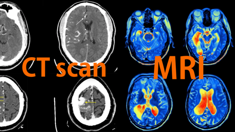 Detail Gambar Hasil Ct Scan Tumor Otak Nomer 26