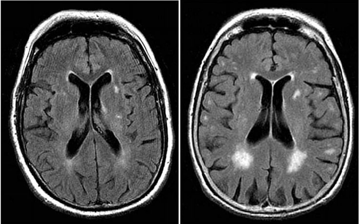 Detail Gambar Hasil Ct Scan Tumor Otak Nomer 30