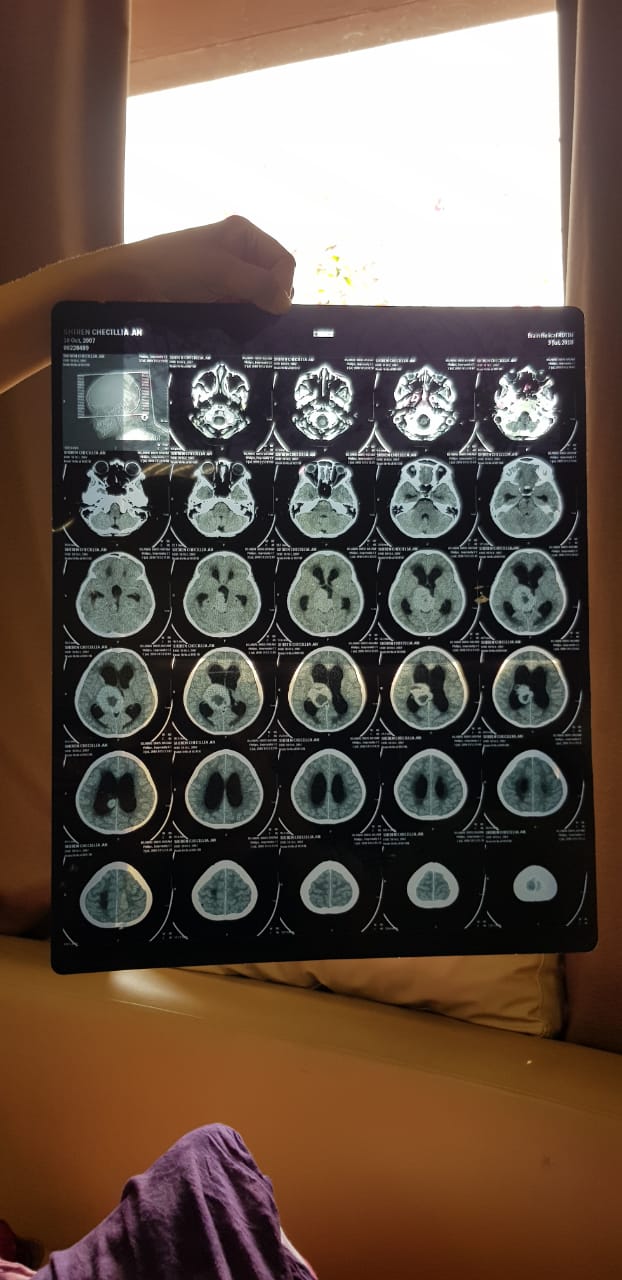Detail Gambar Hasil Ct Scan Tumor Otak Nomer 35