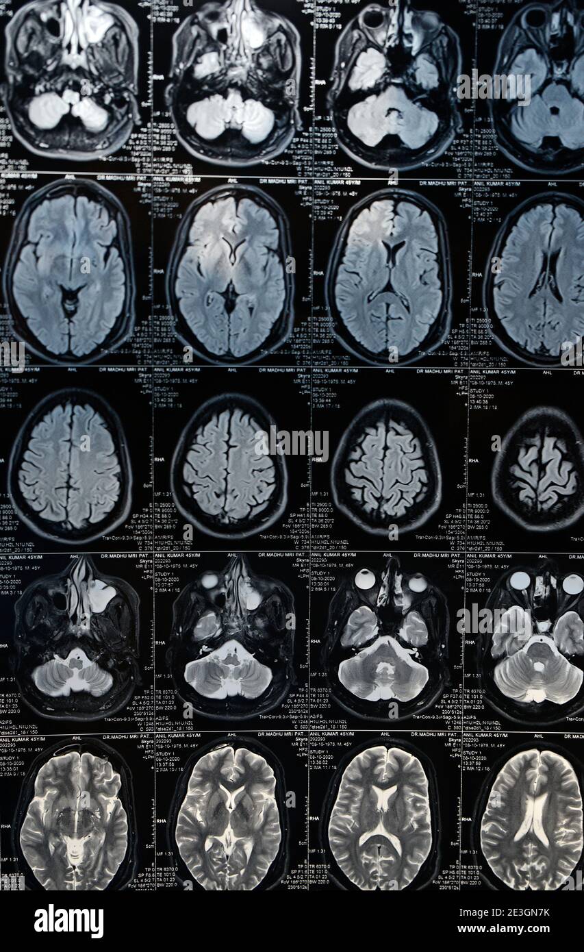 Detail Gambar Hasil Ct Scan Tumor Otak Nomer 38