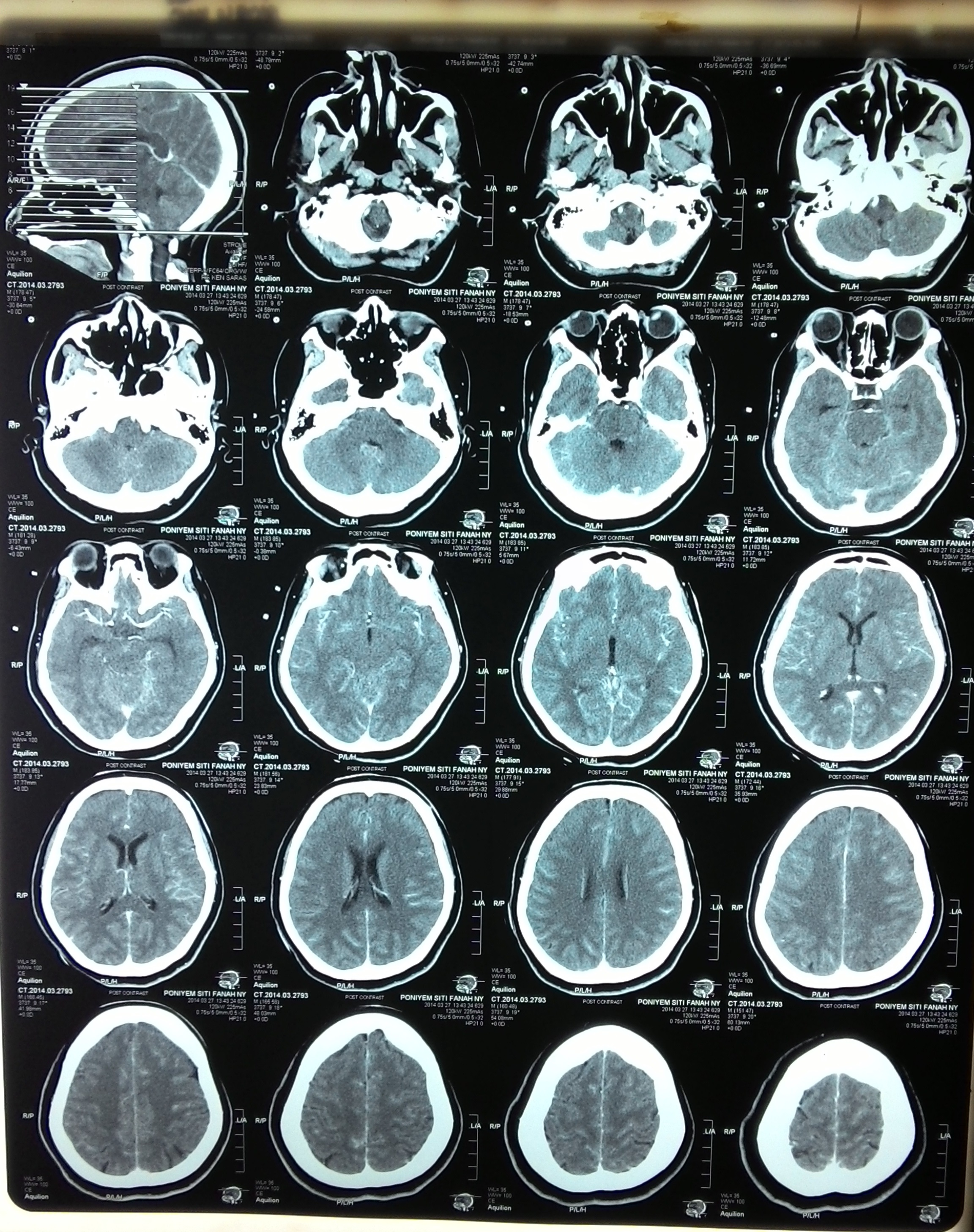 Detail Gambar Hasil Ct Scan Tumor Otak Nomer 41
