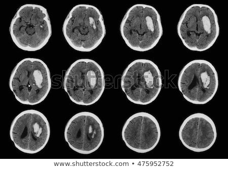 Detail Gambar Hasil Ct Scan Tumor Otak Nomer 8