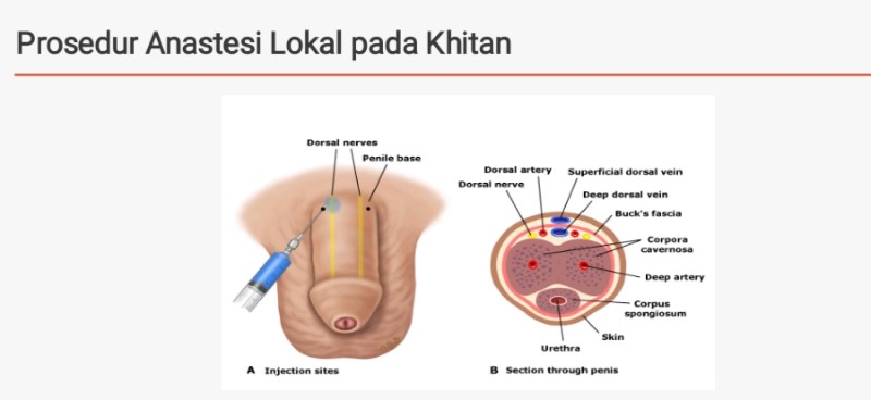 Detail Gambar Hasil Sunat Yang Bagus Nomer 20