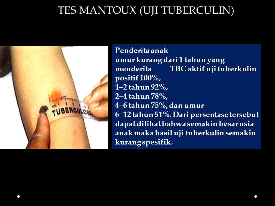 Detail Gambar Hasil Tes Mantoux Negatif Nomer 25