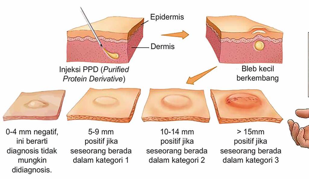 Detail Gambar Hasil Tes Mantoux Negatif Nomer 46