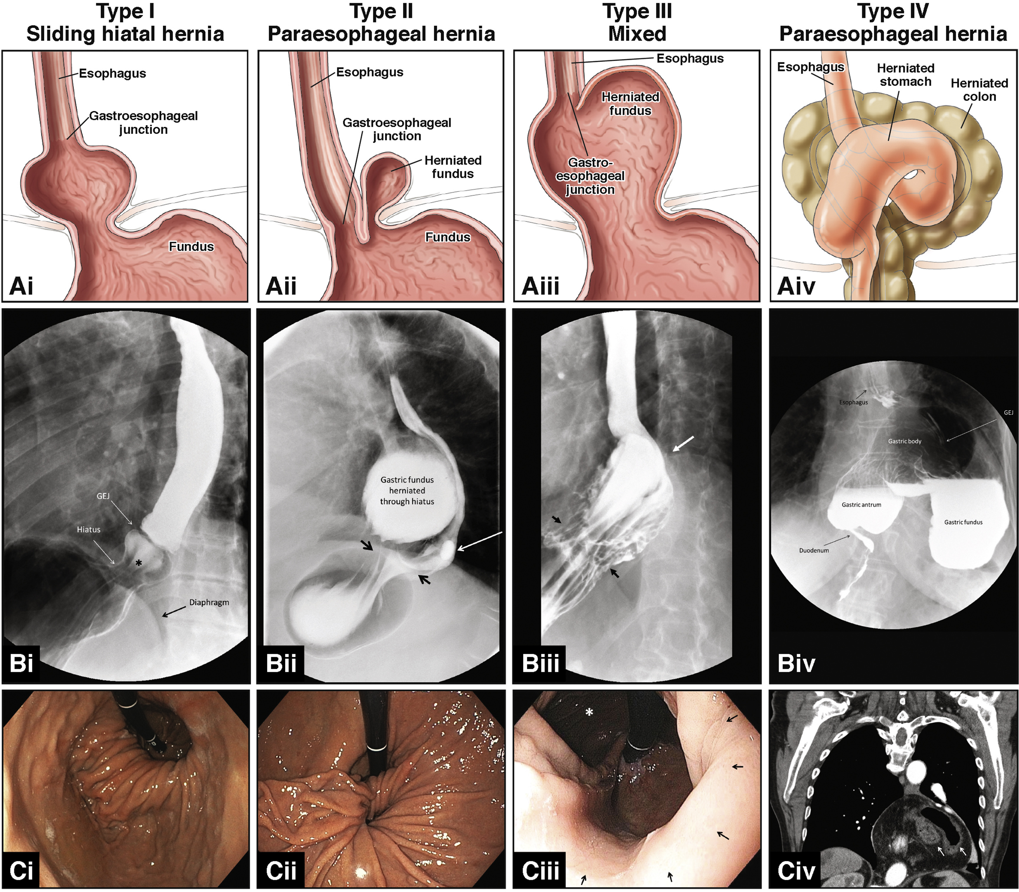 Detail Gambar Hernia Hianatal Lengkap Nomer 15