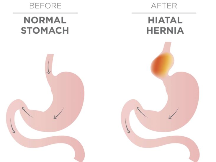 Detail Gambar Hernia Hianatal Lengkap Nomer 19