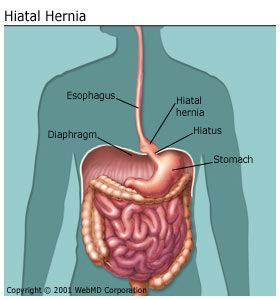 Detail Gambar Hernia Hianatal Lengkap Nomer 3