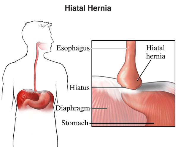 Detail Gambar Hernia Hianatal Lengkap Nomer 22