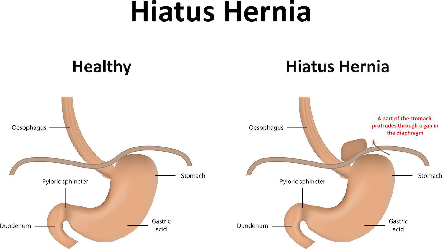 Detail Gambar Hernia Hianatal Lengkap Nomer 29