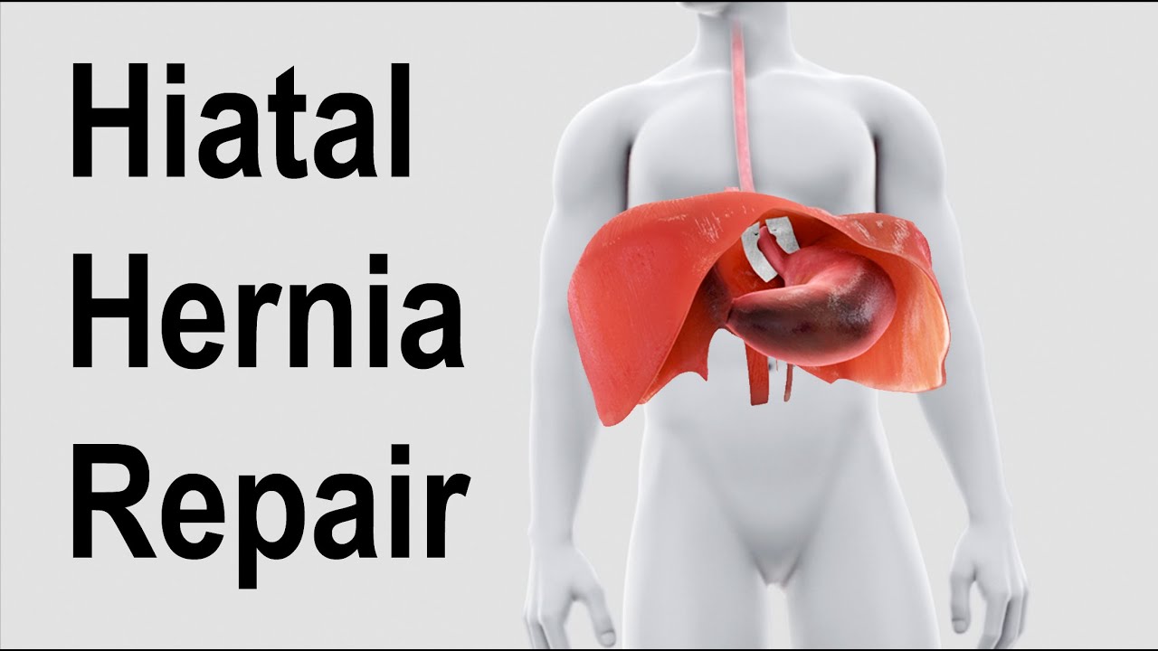 Detail Gambar Hernia Hianatal Lengkap Nomer 33