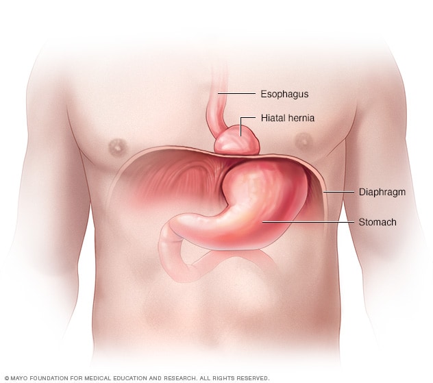 Detail Gambar Hernia Hianatal Lengkap Nomer 5