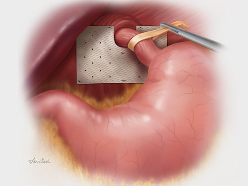 Detail Gambar Hernia Hianatal Lengkap Nomer 41