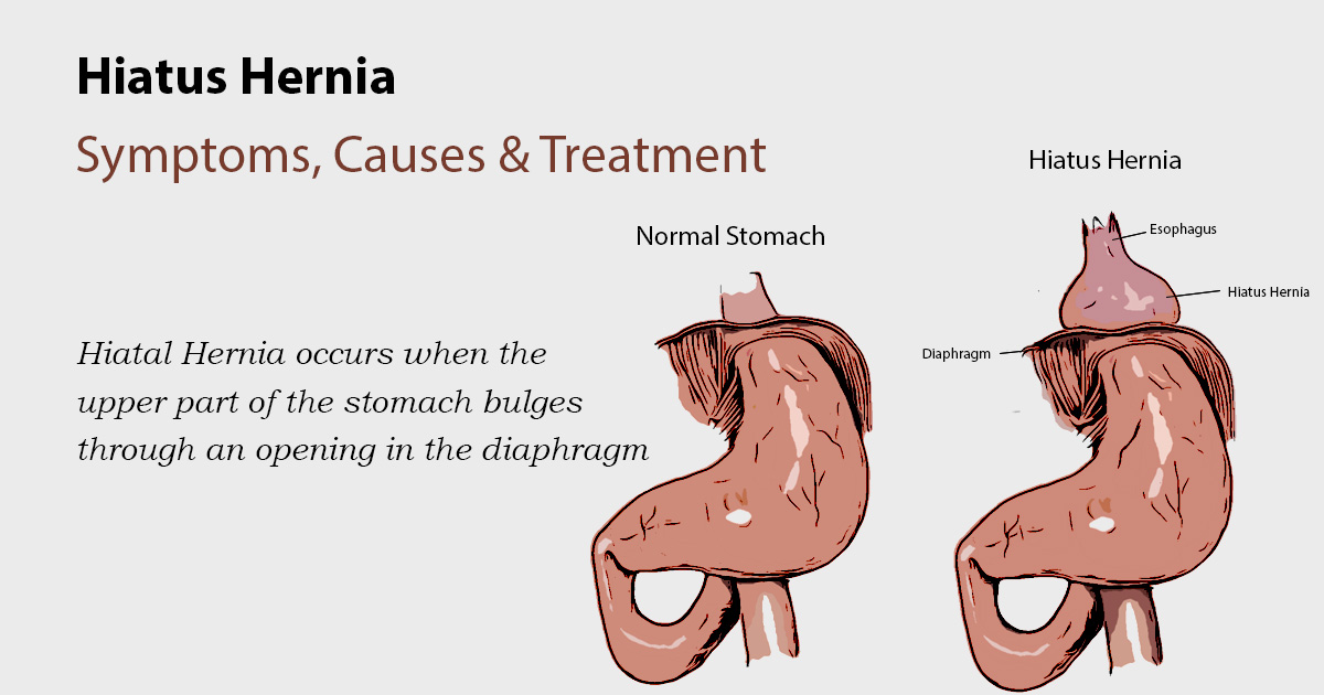 Detail Gambar Hernia Hianatal Lengkap Nomer 6