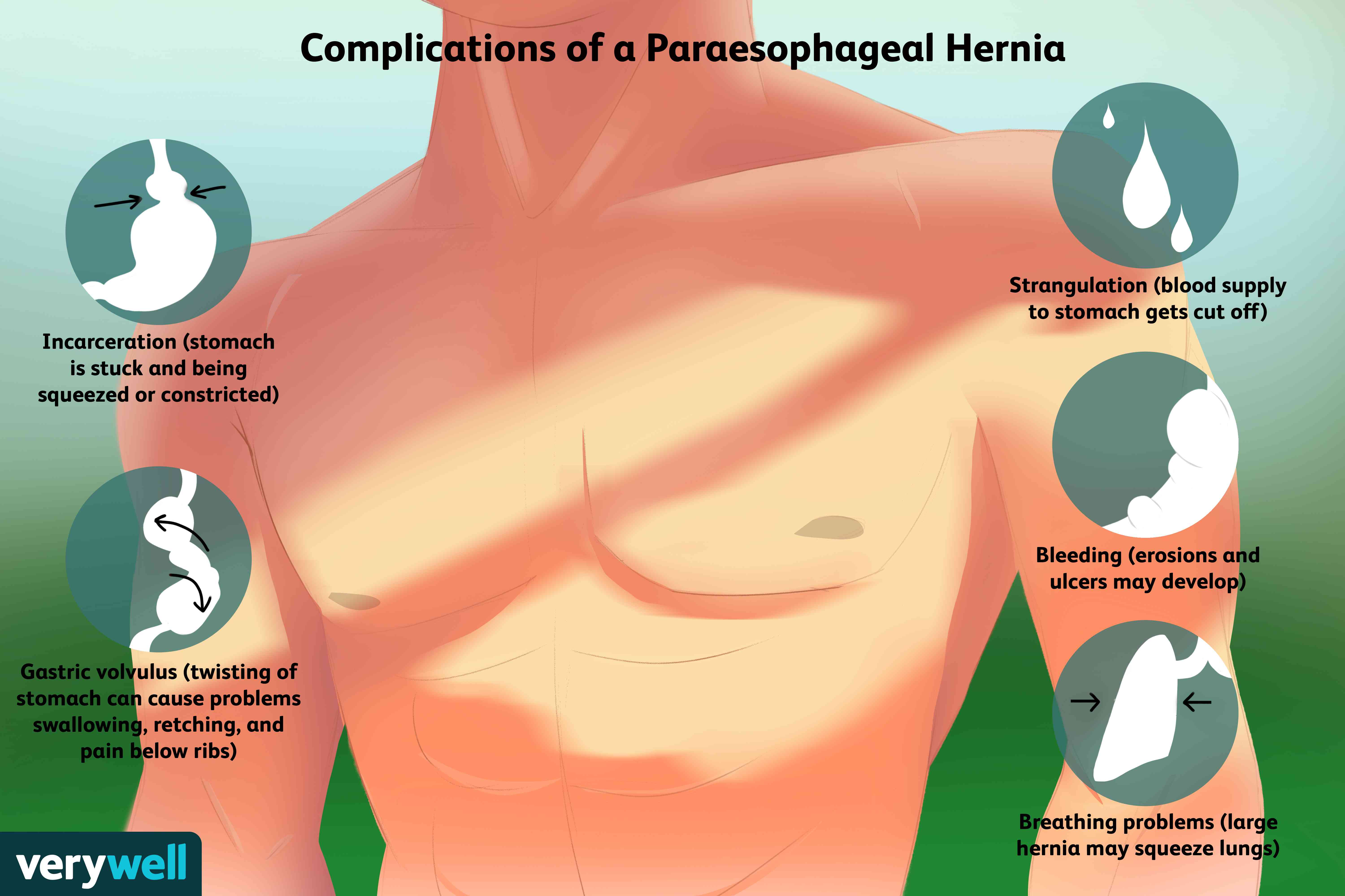 Detail Gambar Hernia Hianatal Lengkap Nomer 55