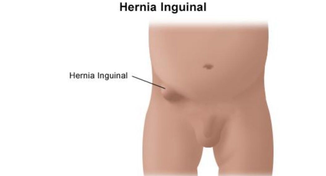 Detail Gambar Hernia Inguinalis Pada Bayi Nomer 13