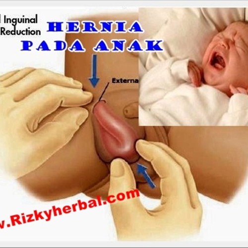 Detail Gambar Hernia Inguinalis Pada Bayi Nomer 21