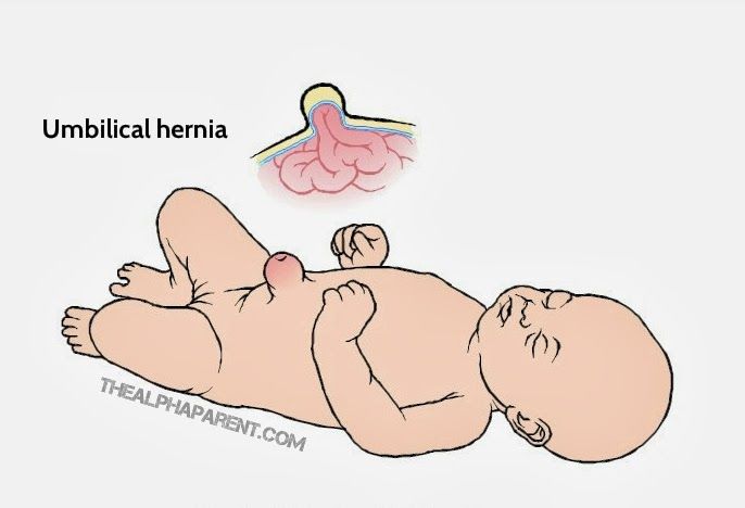 Detail Gambar Hernia Inguinalis Pada Bayi Nomer 25