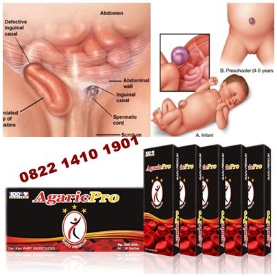 Detail Gambar Hernia Inguinalis Pada Bayi Nomer 37