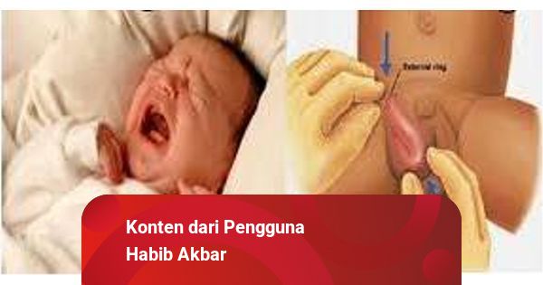 Detail Gambar Hernia Inguinalis Pada Bayi Nomer 50