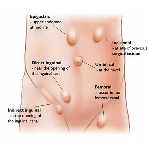 Detail Gambar Hernia Wanita Nomer 26