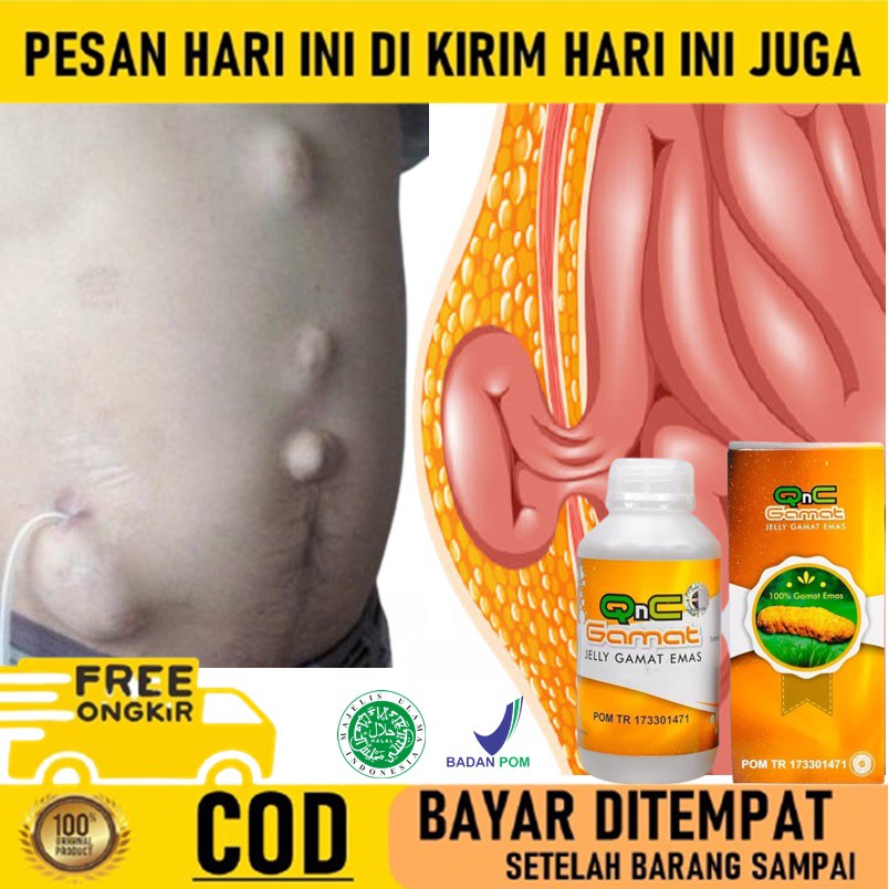 Detail Gambar Hernia Wanita Nomer 56