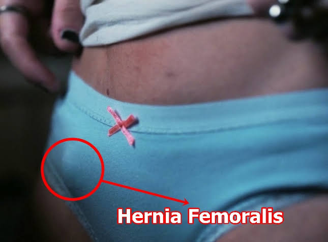 Detail Gambar Hernia Wanita Nomer 5