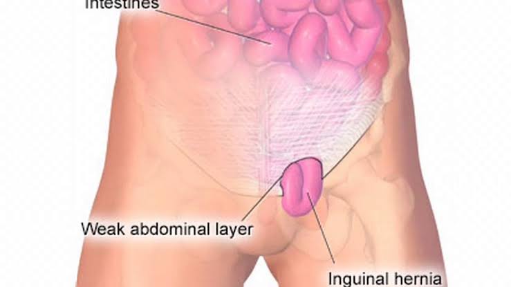 Detail Gambar Hernia Wanita Nomer 7